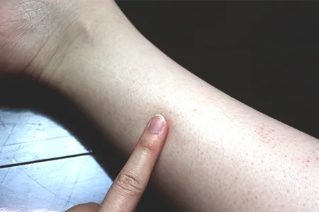 トリアは痛い？痛みの部位差と対策