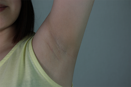 脱毛キャンペーンが“怪しい”と感じる理由