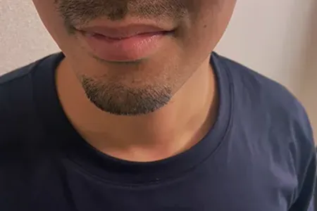 ヒゲ脱毛は痛い?結論から言うと「対策すれば耐えられる」