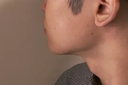 ヒゲ脱毛1回の施術時間はどのくらい？