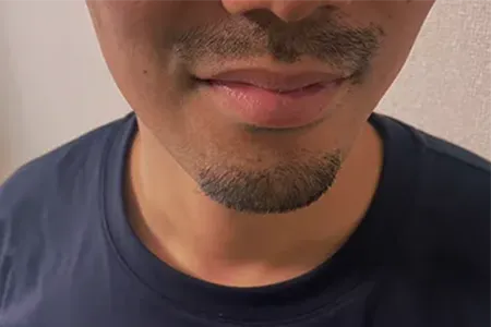 青髭対策におすすめのカミソリ・電動シェーバー