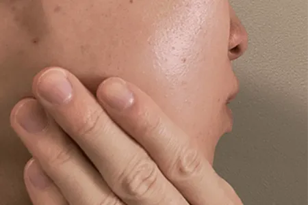 髭剃り後に肌荒れが起こる原因｜赤み・ヒリつき・ニキビのメカニズム