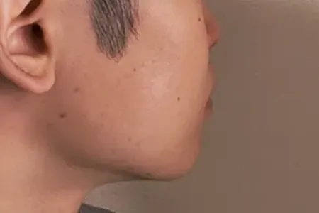 ヒゲを毛抜きで抜いたら生えて来なくなるのか・何日で生えてくるのか