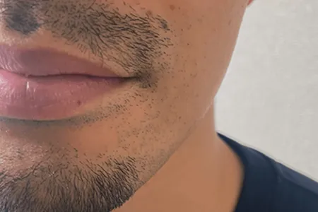 毛抜きでヒゲを抜くメリット