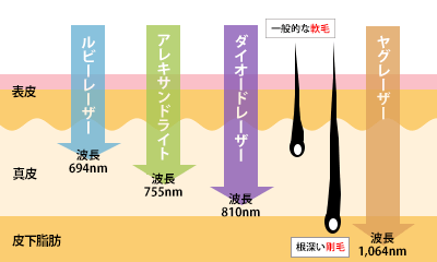 レーザーの説明